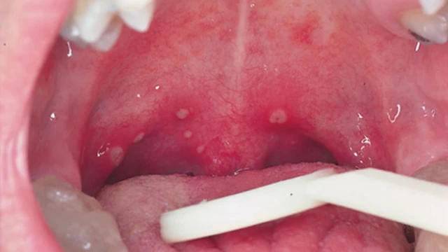 bai-viet/benh-herpangina-duong-lay-truyen-trieu-chung-chan-doan-dieu-tri.html