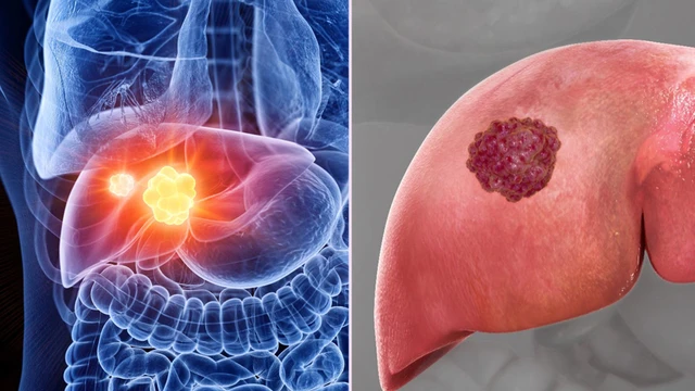 bai-viet/cach-phong-tranh-ung-thu-gan-don-gian-nhung-hieu-qua.html