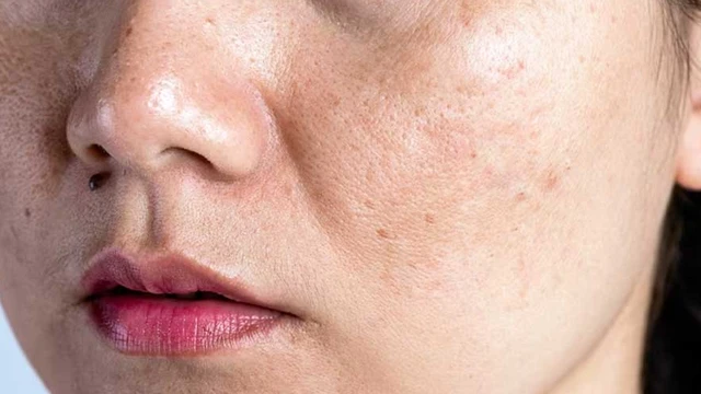 bai-viet/da-noi-dom-nau-khong-ngua-la-do-nguyen-nhan-nao.html