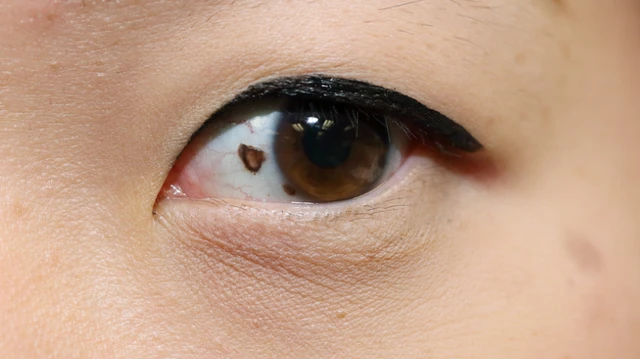 bai-viet/dom-nau-trong-mat-la-gi-do-nhung-nguyen-nhan-nao-gay-ra.html