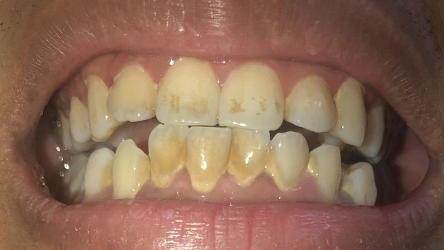 bai-viet/giai-dap-rang-nhiem-khang-sinh-co-tay-duoc-khong.html