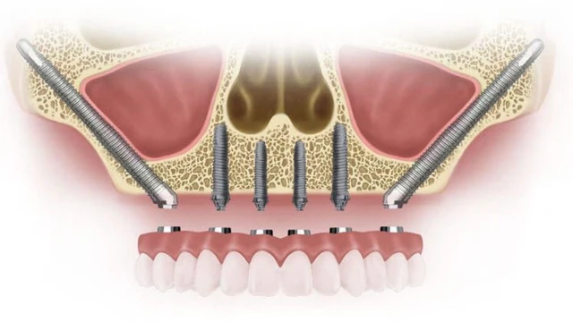 bai-viet/ham-thao-lap-tren-implant-la-gi-uu-nhuoc-diem-va-cac-luu-y-khi-su-dung.html