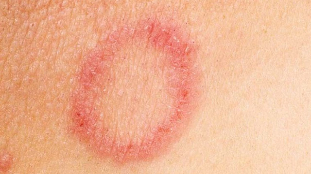 bai-viet/hien-tuong-bi-noi-vong-tron-do-tren-da-la-do-benh-ly.html