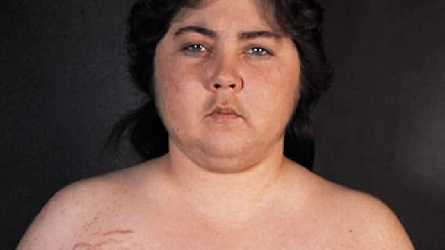 bai-viet/nguoi-mac-hoi-chung-cushing-nen-an-gi-va-kieng-gi.html