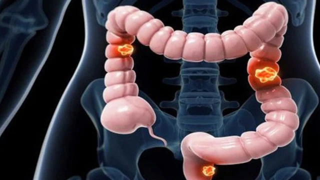 bai-viet/ket-trang-la-gi-cac-benh-ly-thuong-gap-o-ket-trang-va-cach-phong-chong.html