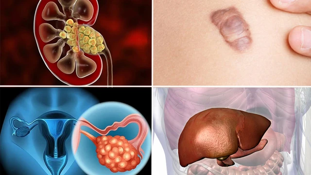 bai-viet/nang-la-gi-nguyen-nhan-gay-u-nang-va-phuong-phap-dieu-tri.html