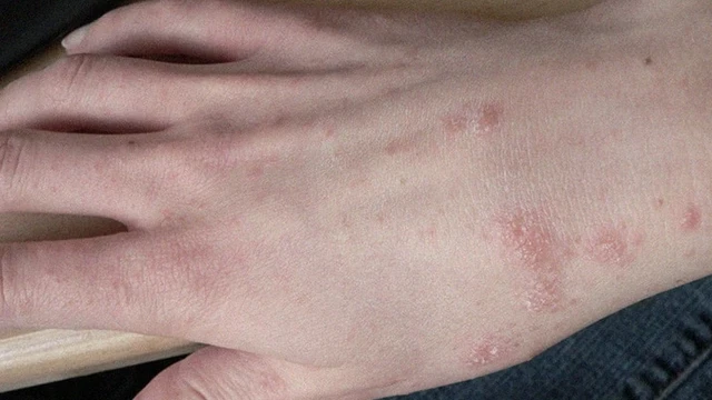 bai-viet/nhan-biet-cac-dau-hieu-bi-ghe-va-cach-dieu-tri-hieu-qua.html