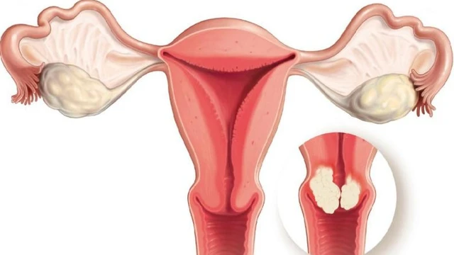 bai-viet/nhan-xo-tu-cung-khac-gi-u-xo-tu-cung.html