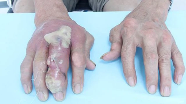 bai-viet/nhiem-trung-hat-tophi-la-gi-co-nguy-hiem-khong-va-cach-dieu-tri-the-nao.html