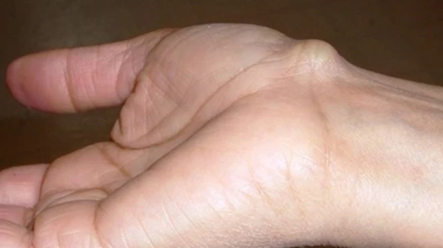 bai-viet/noi-cuc-o-mu-ban-tay-la-gi-nguyen-nhan-va-cach-dieu-tri-ra-sao.html