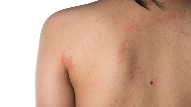 bai-viet/noi-man-do-o-lung-khong-ngua-la-do-benh-gi.html