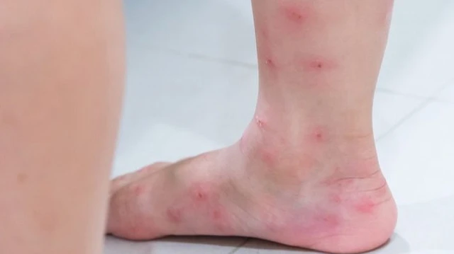 bai-viet/noi-man-ngua-o-bap-chan-la-do-nhung-nguyen-nhan-nao.html