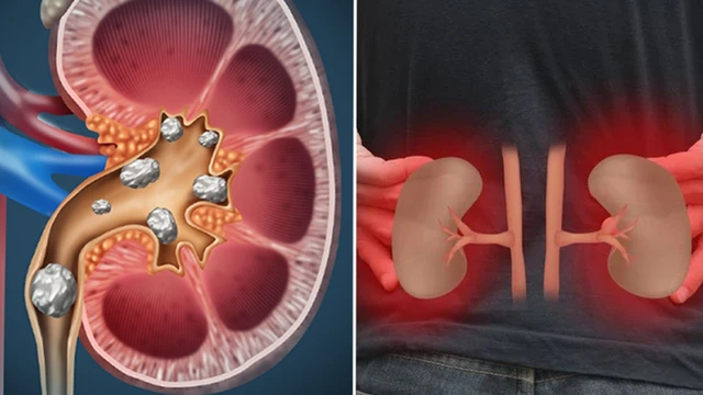 bai-viet/soi-than-dai-duoi-la-gi-nguyen-nhan-dau-hieu-nhan-biet-va-cach-phong-ngua.html