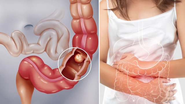 bai-viet/tac-ruot-do-ba-thuc-an-la-gi-co-nguy-hiem-khong.html