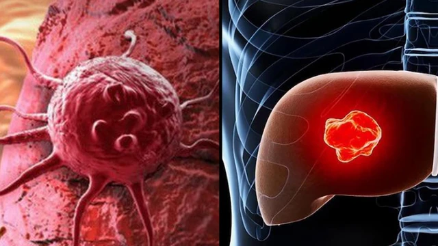 bai-viet/u-gan-ac-tinh-song-duoc-bao-lau-dau-hieu-nhan-biet-va-yeu-to-lam-tang-nguy-co.html