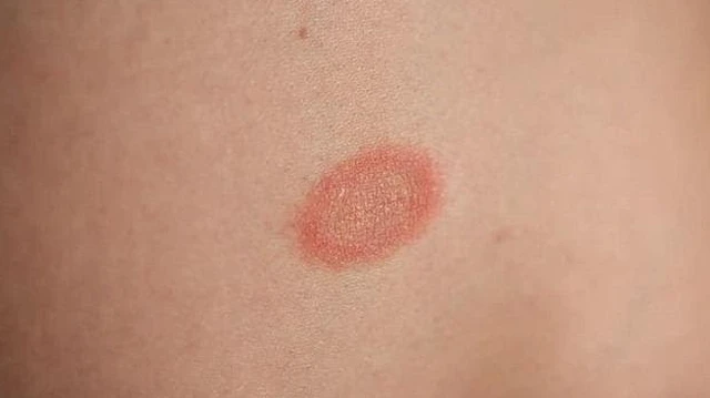 bai-viet/cac-phuong-phap-dieu-tri-benh-vay-nen-nhe.html