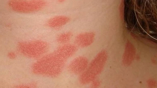 bai-viet/vay-nen-phan-hong-la-gi-benh-co-nguy-hiem-khong.html