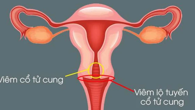 bai-viet/viem-co-tu-cung-va-viem-lo-tuyen-co-tu-cung-co-giong-nhau-khong.html