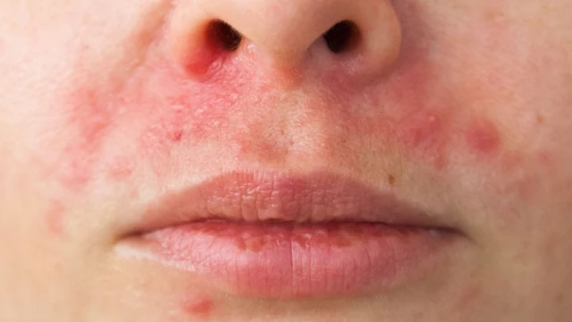 bai-viet/viem-da-quanh-mieng-la-benh-gi-co-nguy-hiem-khong.html