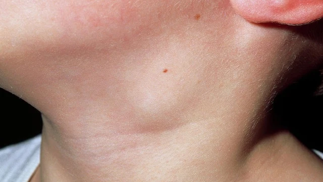 bai-viet/viem-hach-bach-huyet-la-benh-gi-trieu-chung-the-nao.html