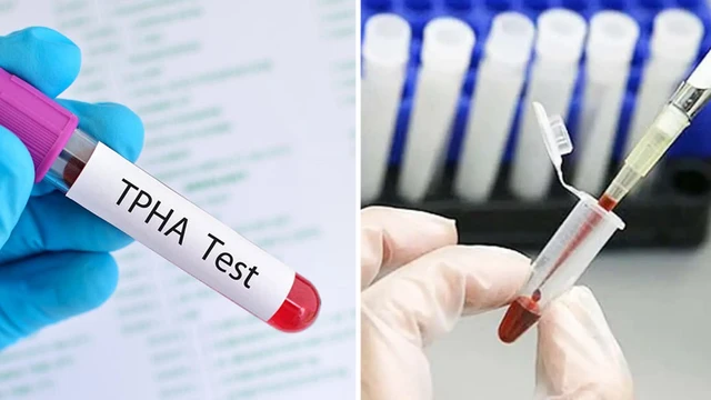 bai-viet/xet-nghiem-giang-mai-bao-nhieu-tien-co-duoc-huong-bao-hiem-y-te-khong.html