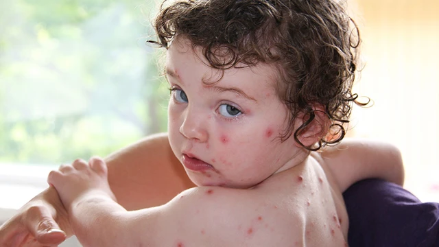 bai-viet/ban-da-biet-nguyen-nhan-benh-thuy-dau-la-gi-hay-chua.html