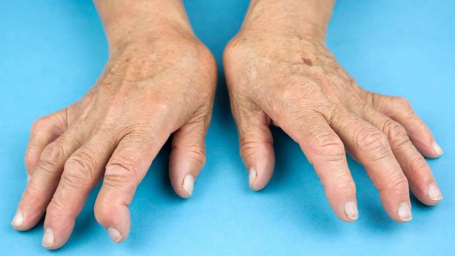 bai-viet/ban-tay-gio-thoi-la-bien-chung-cua-benh-gi-do-nguyen-nhan-nao.html