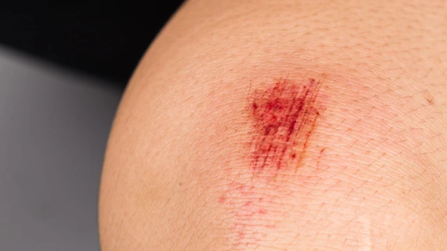 bai-viet/bao-lau-da-non-het-do-5-cach-cham-soc-vet-thuong-len-da-non.html