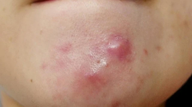 bai-viet/bat-mi-cach-tri-mun-boc-tai-nha-cuc-don-gian-va-hieu-qua-65720.html