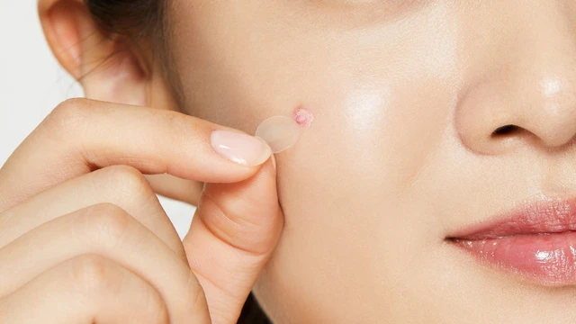 bai-viet/bat-mi-diem-noi-bat-cua-mieng-dan-mun-ban-ngay-derma-angel.html