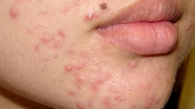 bai-viet/bat-mi-nhung-loai-kem-tri-mun-boc-tot-nhat-tren-thi-truong-hien-nay-65725.html