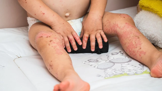 bai-viet/be-bi-tay-chan-mieng-lan-2-muc-do-nghiem-trong-va-cach-dieu-tri.html