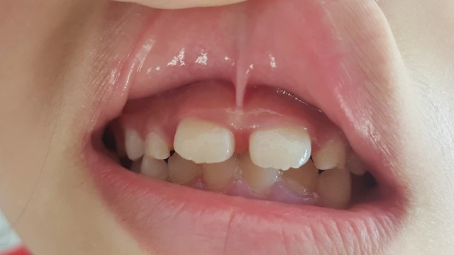 bai-viet/be-bi-dinh-thang-luoi-la-nhu-the-nao-co-nguy-hiem-khong-64944.html