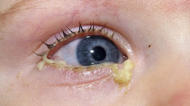 bai-viet/be-bi-sot-ho-so-mui-mat-do-ghen-thi-phai-lam-sao-65055.html