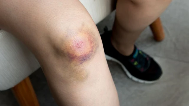 bai-viet/be-hay-bi-vet-bam-tim-o-chan-nguyen-nhan-va-cach-xu-tri-phu-hop.html