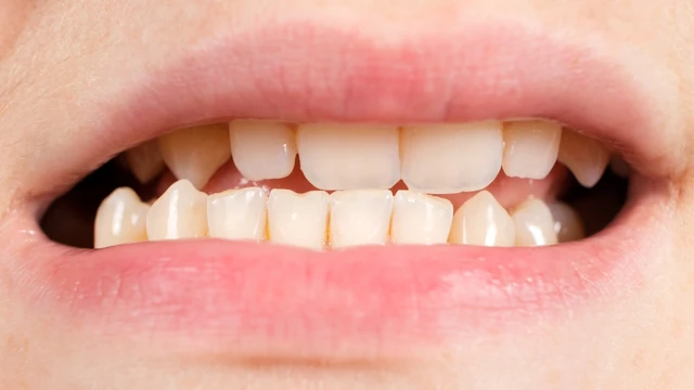 bai-viet/be-thay-rang-moc-lech-phai-lam-sao-cach-phong-ngua-va-xu-ly.html