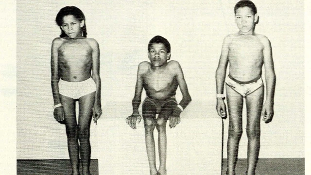 bai-viet/hieu-dung-va-du-ve-benh-morquio-roi-loan-chuyen-hoa-di-truyen-hiem-gap.html