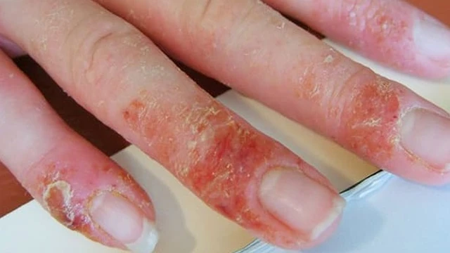 bai-viet/benh-a-sung-o-tay-meo-chua-tri-hieu-qua-bang-phuong-phap-dan-gian-69221.html