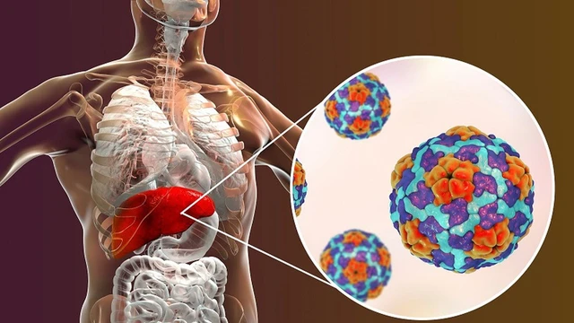 bai-viet/benh-ap-xe-gan-co-lay-khong-nhung-dieu-can-biet-ve-ap-xe-gan-72461.html