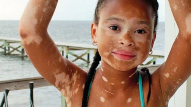 bai-viet/benh-bach-bien-o-tre-em-va-cac-bien-phap-dieu-tri-59403.html