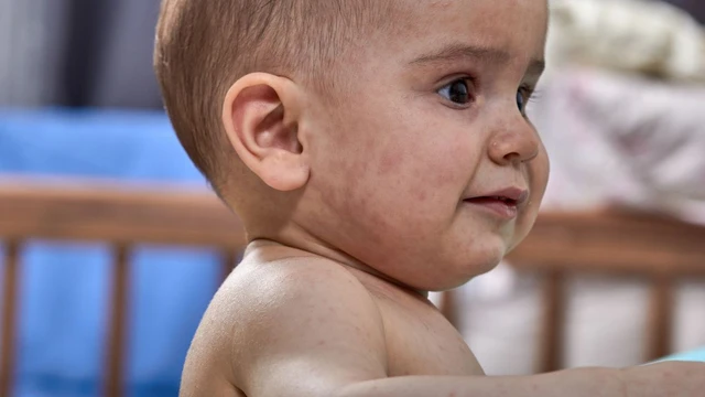 bai-viet/benh-ban-dao-nguyen-nhan-trieu-chung-cach-dieu-tri.html