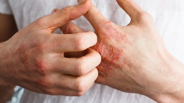 bai-viet/benh-cham-cap-tinh-la-gi-co-nguy-hiem-den-suc-khoe-khong-52897.html