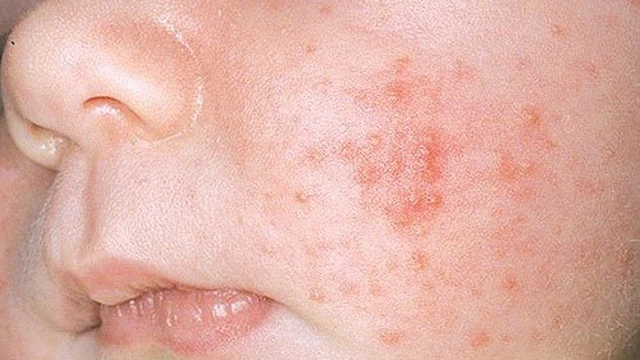 bai-viet/nguyen-nhan-va-cach-dieu-tri-hieu-qua-khi-tre-bi-cham-kho.html