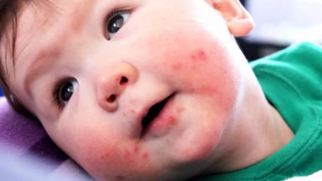 bai-viet/benh-chan-tay-mieng-can-kieng-gi-de-dat-hieu-qua-dieu-tri-72382.html