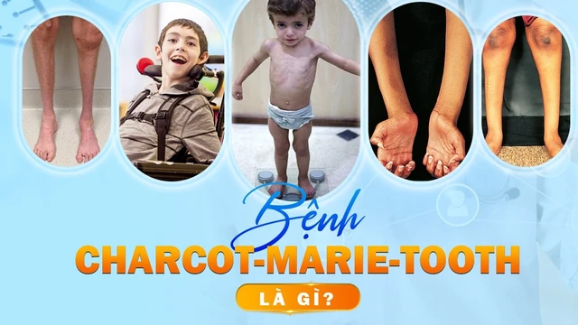 bai-viet/benh-charcot-marie-tooth-la-benh-gi.html