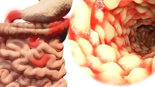 bai-viet/benh-crohn-cua-dai-trang-nguyen-nhan-va-phuong-phap-dieu-tri-hieu-qua-56881.html