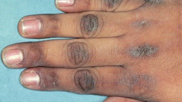 bai-viet/thac-mac-benh-gai-den-co-chua-duoc-khong.html