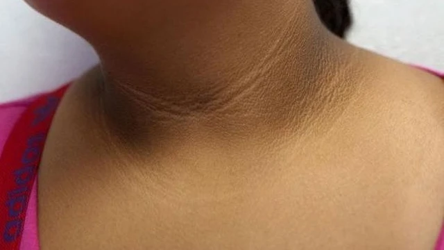 bai-viet/benh-gai-den-o-co-nguyen-nhan-trieu-chung-va-phuong-phap-dieu-tri.html