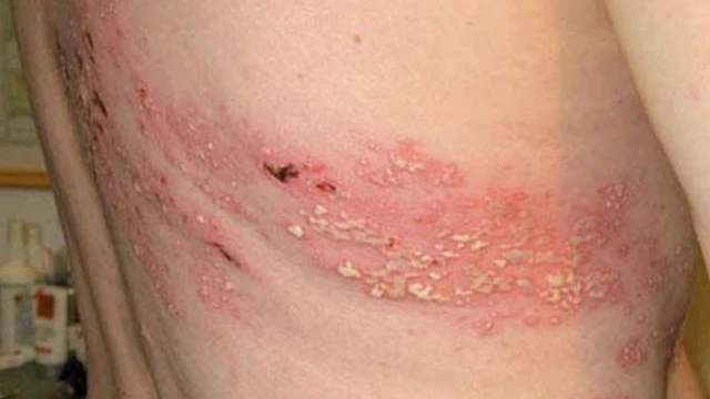 bai-viet/benh-gioi-leo-co-nguy-hiem-khong-co-lay-khong-35711.html