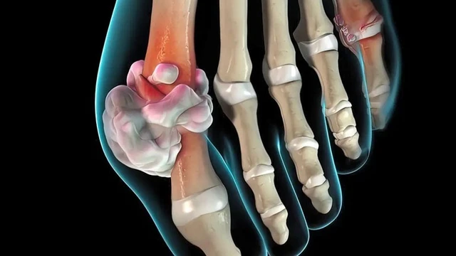 bai-viet/benh-gut-vo-can-co-nguy-hiem-khong.html